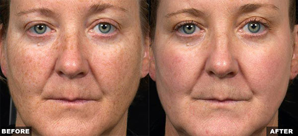 fraxel-dual-face-pigmentation