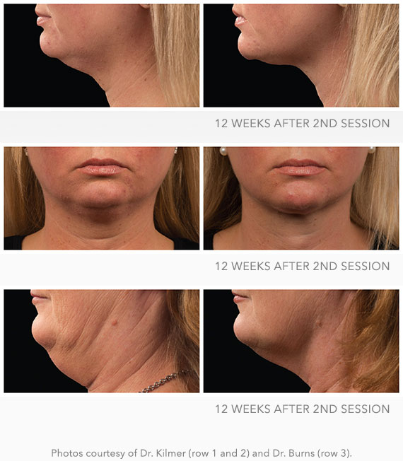 Two women lower face before and after treatment with Kybella showing reduced fat beneath their chins 12 weeks after 2nd session