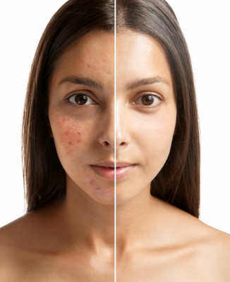 Young woman showing split face comparison of acne on one side and clear skin on the other