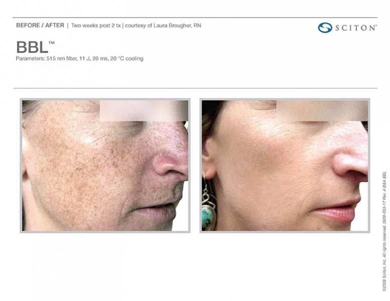 Young woman's face after BBL Intense Pulsed Light with visible reduction of pigmentation
