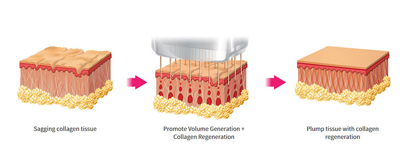 Genius-real-collagen-vol-image2