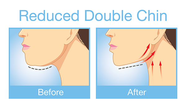 Get Rid of Your Double Chin Without Surgery or Injections | LA