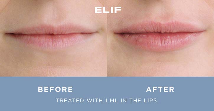 Restylane Kysse Lip Filler Results after injection of 1 ml product