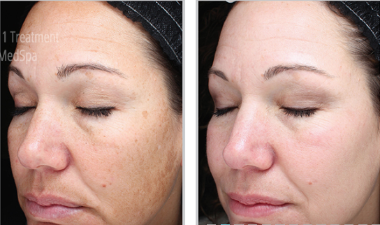 Woman right angle face before and after Halo laser for improved pigmentation and smoothness