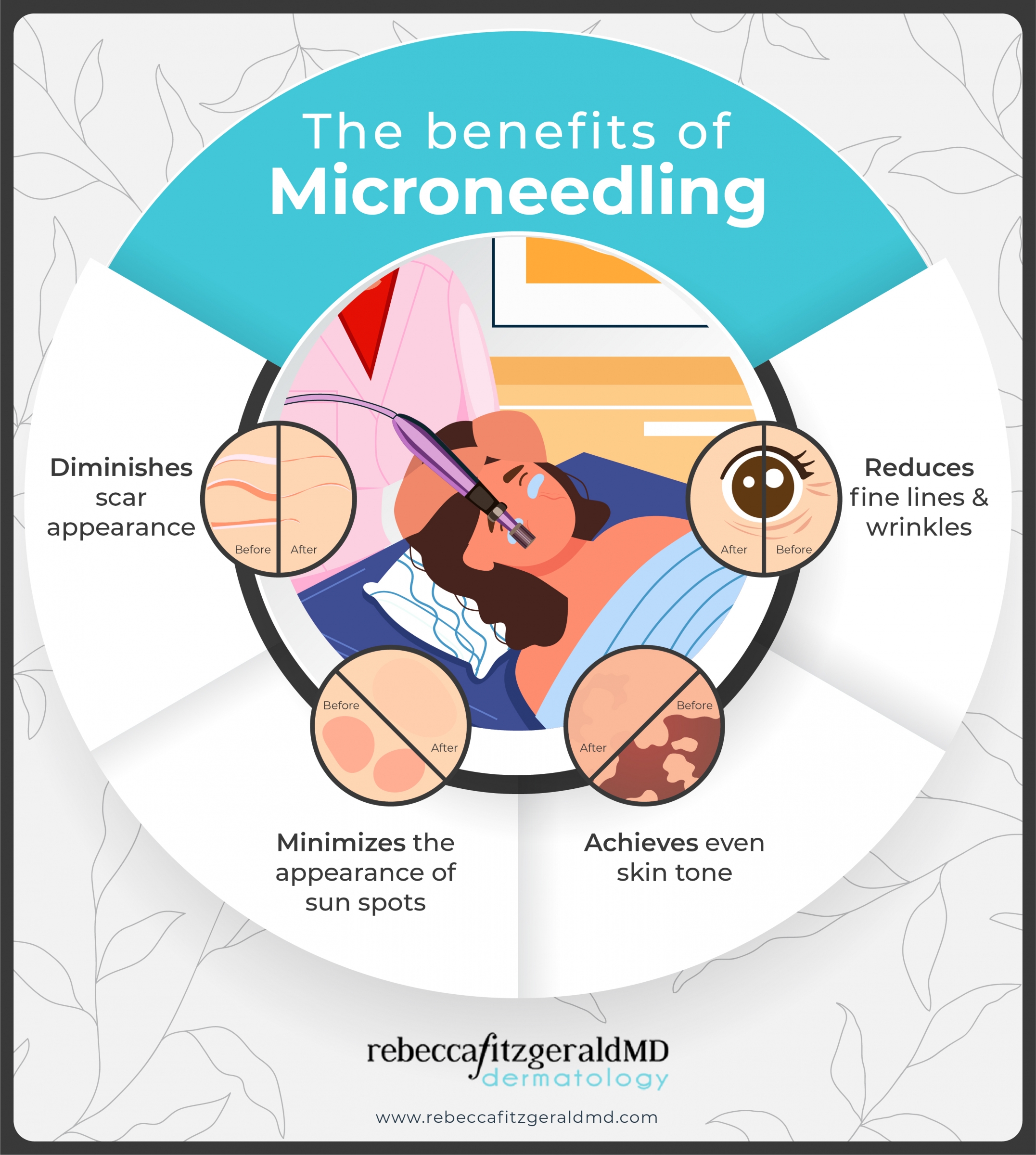 An infographic showing a cartoon woman getting a skin treatment and listing the benefits of microneeding including diminishing scar, minimizing sun spots, evening skin tone and reducing fine lines
