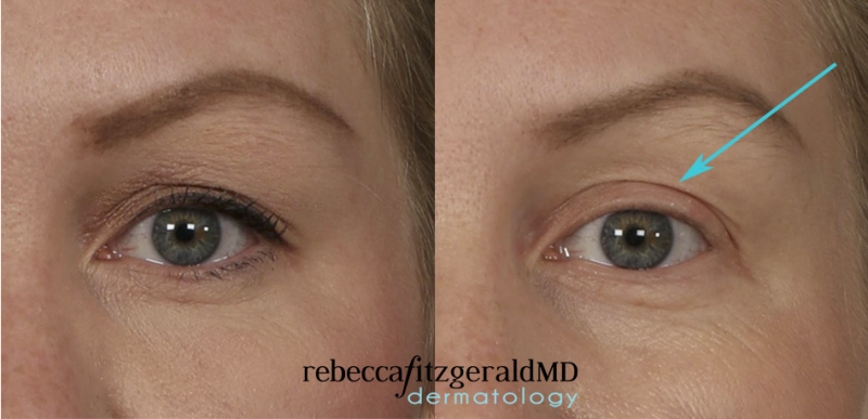 Thermage Eyes treatment Result Front showing lifted and smoother lid