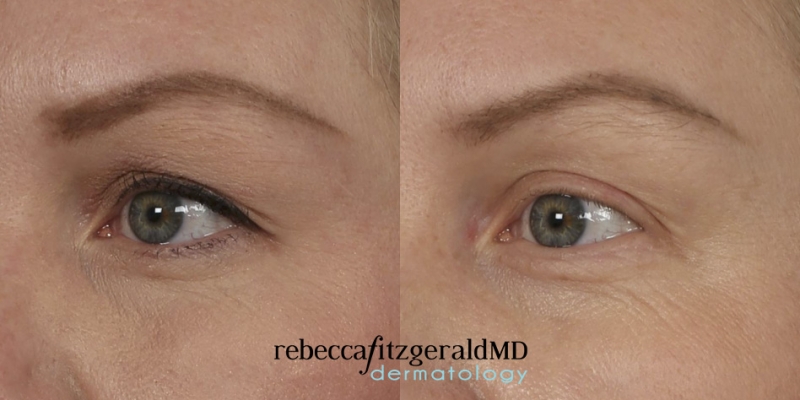 Thermage Eyes Results Angle showing results on eyelids