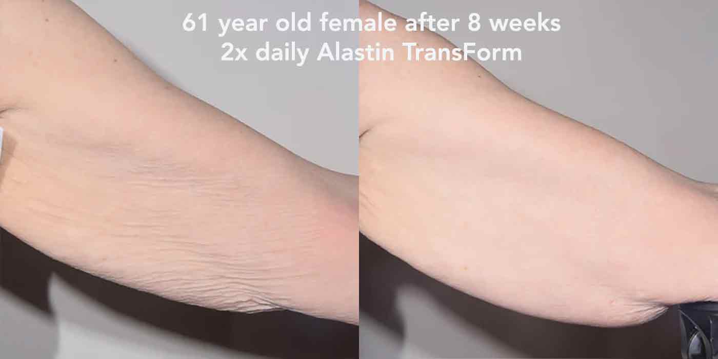 Results of  Alastin Transform body lotion used for 8 weeks on crepey skin of upper arm