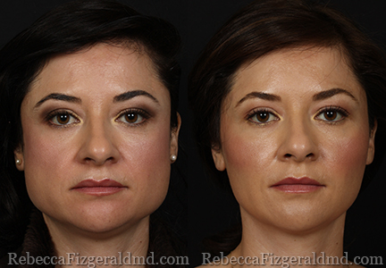 Botox for jaw reduction younger patient with enlarged master muscle side by side before and after treatment resulting in slimmer jaw contour. patient of Dr. Rebecca Fitzgerald