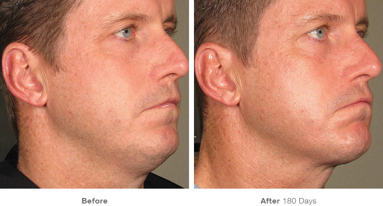 Male patient before and after Ultherapy right side view showing improved lower face contour