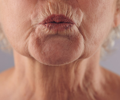 Lip wrinkles