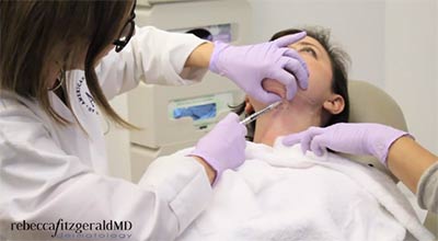 Dr. Fitzgerald injecting Kybella on patient Emily 