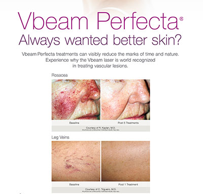 Vbeam Treatment results on face and legs