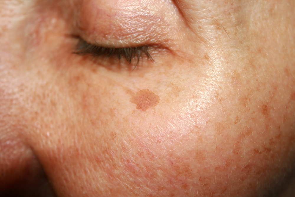 A close up of an age spot on a woman's face below her eye