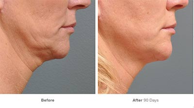 Results of Ultherapy under Chin female patient showing improved lower face contour improvement