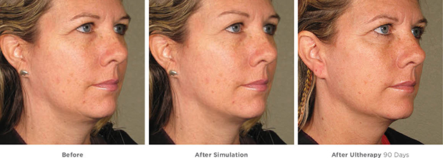 Ultherapy simultation and actual results female patient right side face